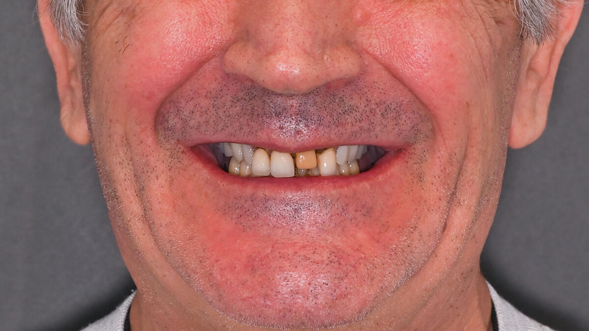 Zâmbet lateral stanga_înainte